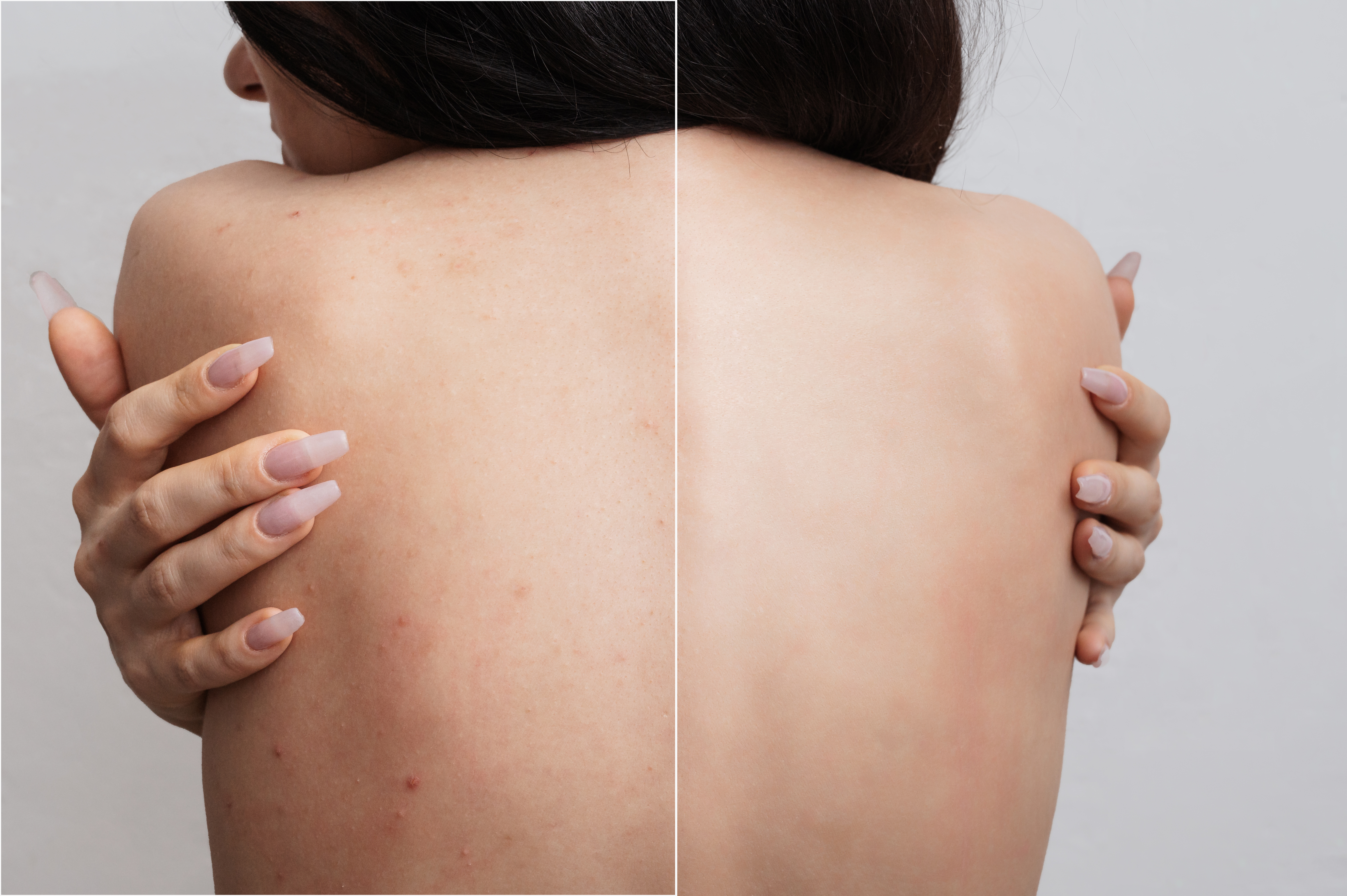 Tại sao detox đúng cách giúp điều hòa nội tiết và giảm mụn nội tiết?